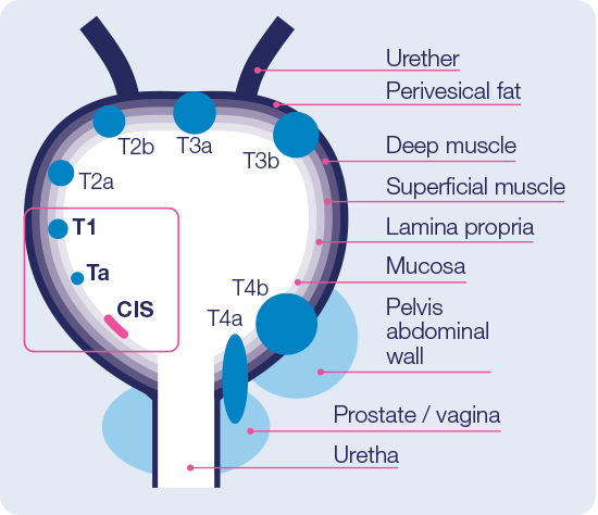 Bladder Cancer Hexvix 